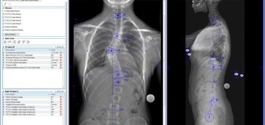 preoperative-planning