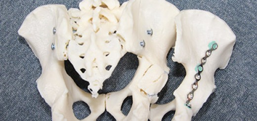 3d_printed_pelvic_bone_model_for_pre_surgury_planning