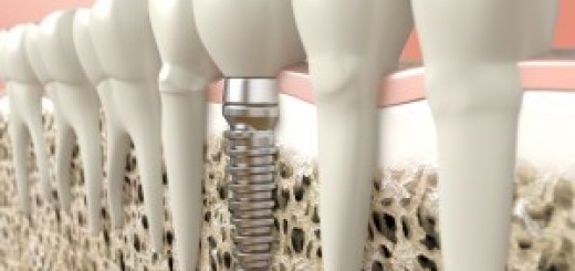 dental-implants