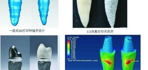 Peking university dental hospital implant