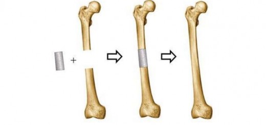 Tissue engineering_Bone